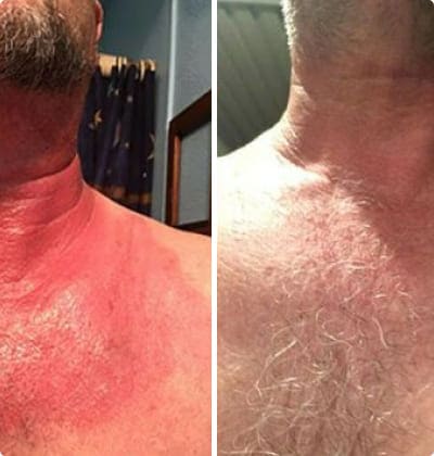 Comment fonctionne Yenki Derm ?