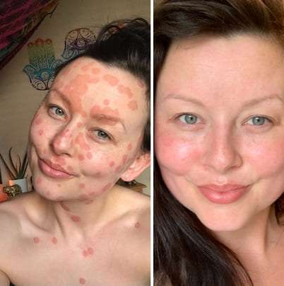 À quoi sert Yenki Derm ?